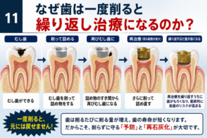 なぜ歯は繰り返し削るのか？